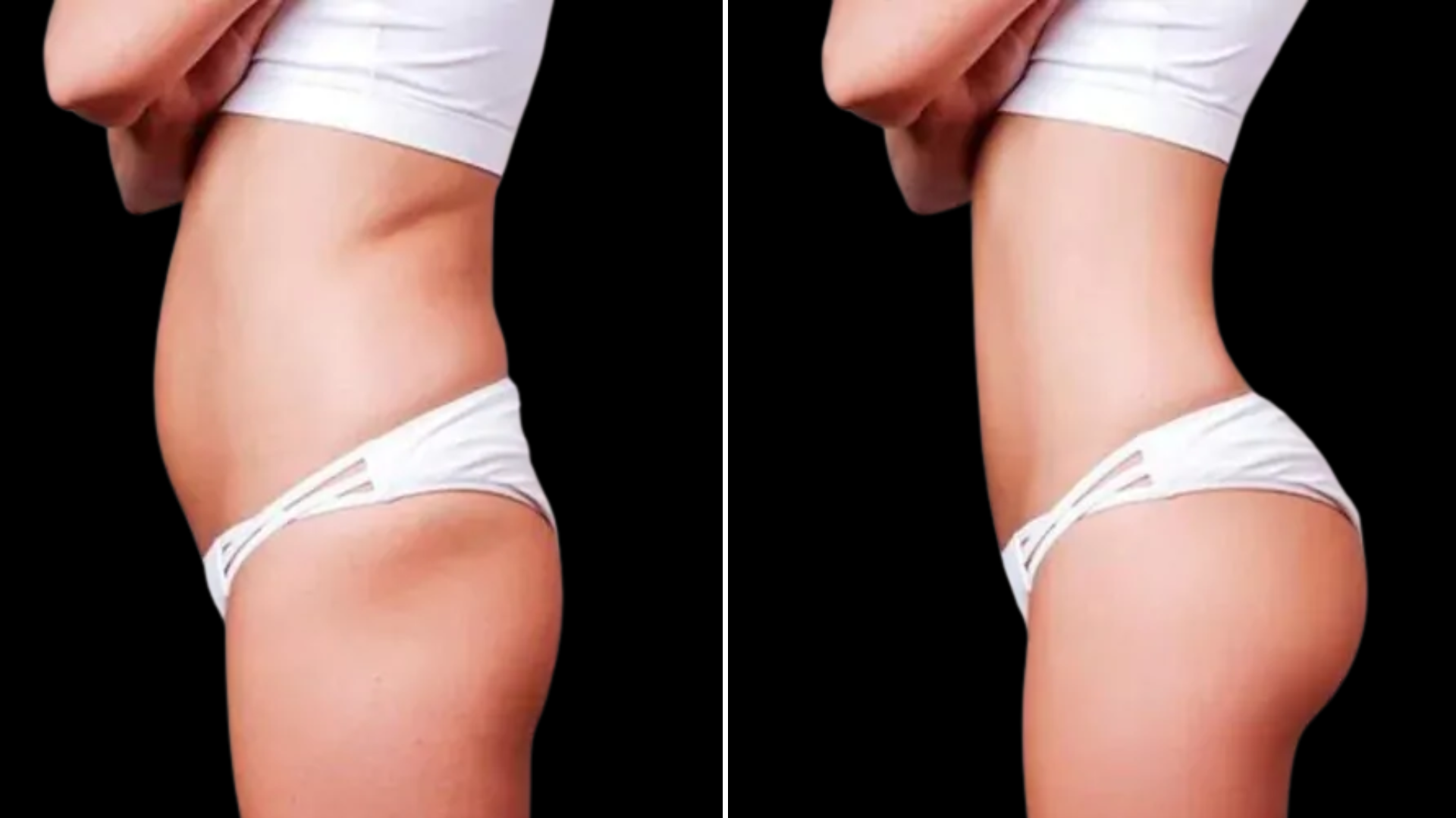 gluteoplastia